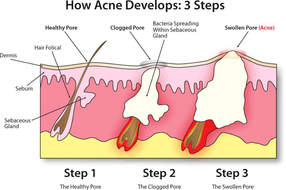 Understanding How Acne Forms and What Makes The Proactiv 