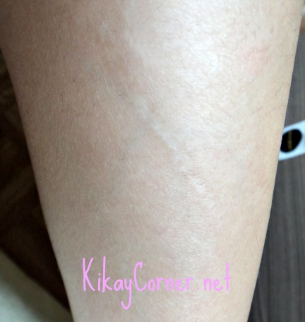 shin scar august 2013 after using contractubex
