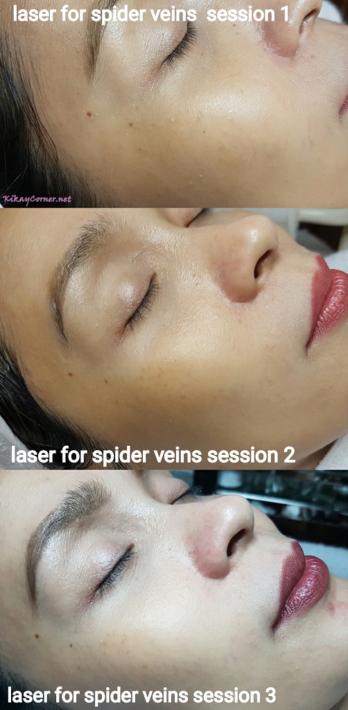 laser treatment for spider veins