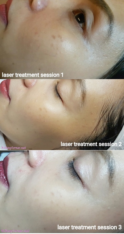 laser treatment for sun spots